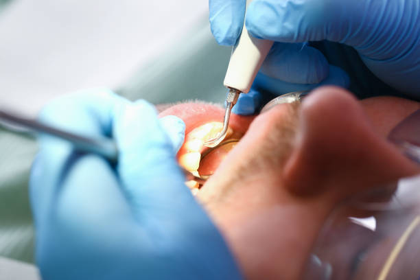 Best Emergency Wisdom Tooth Extraction in USA